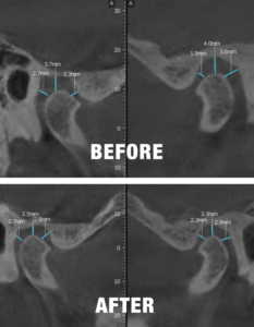 Toomey Technique - TMJ Dentistry - Kehl patient before and after ct scans