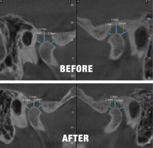 Toomey Technique - TMJ Dentistry - Kehl patient before and after ct scans